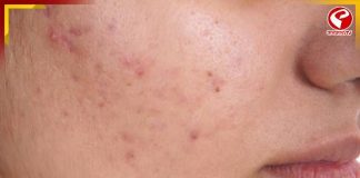 দ্রুত ভ্যানিস হবে ব্রণ, পুজোয় এই দুই উপাদানেই মিলবে নিখুঁত ত্বক