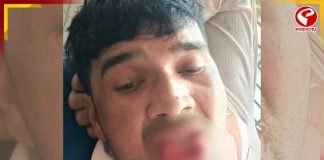 চুমুতেই বিপত্তি! প্রাক্তন প্রেমিকার কামড়ে আংশিক জিভ খোয়াল বিবাহিত যুবক